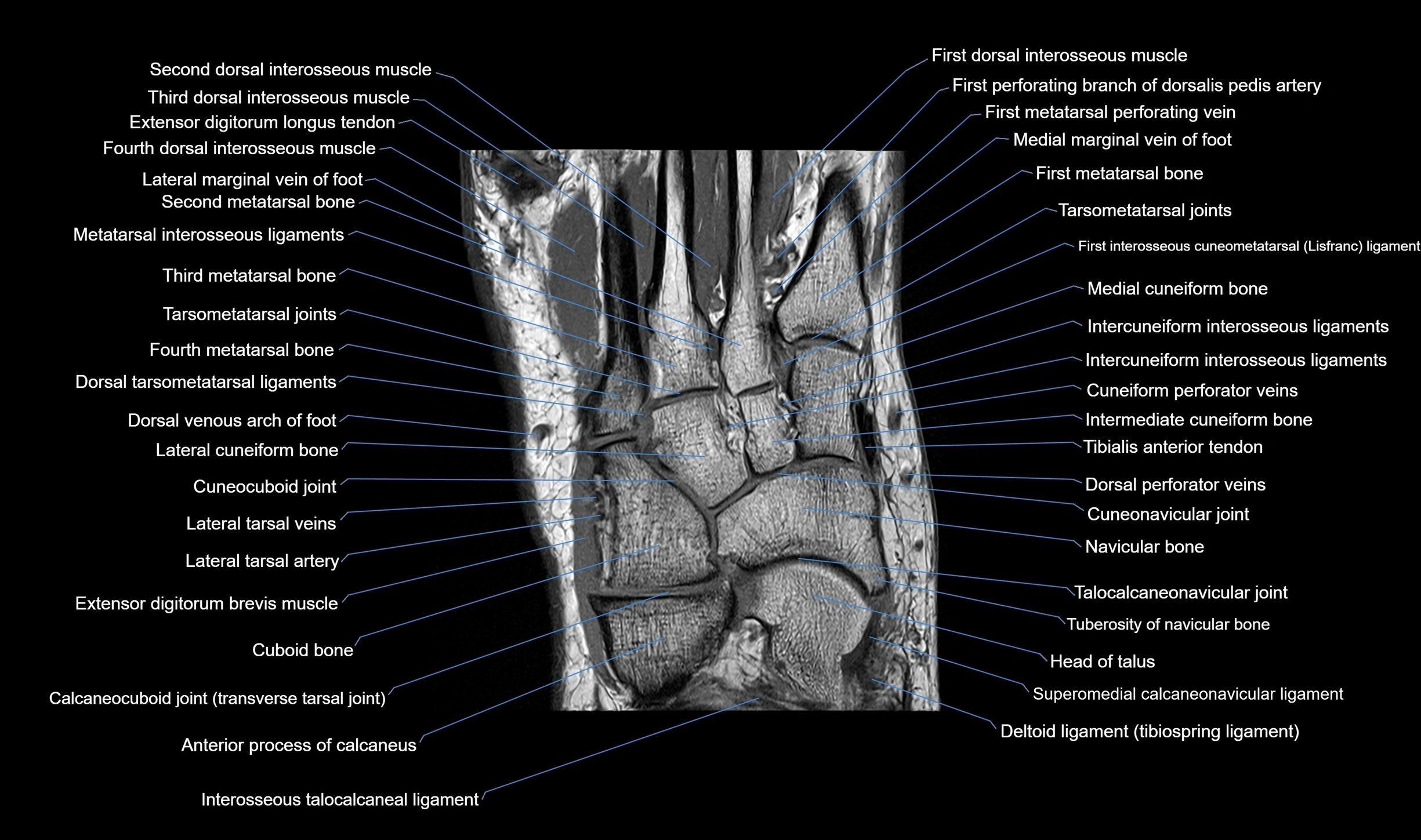 MRI mid foot coronal ligaments cross sectional anatomy 3T  radiology  image-img-00001-00020.webp